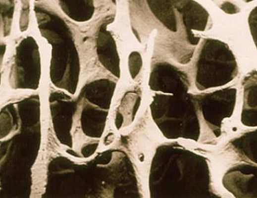 07102013 Osteoporosi