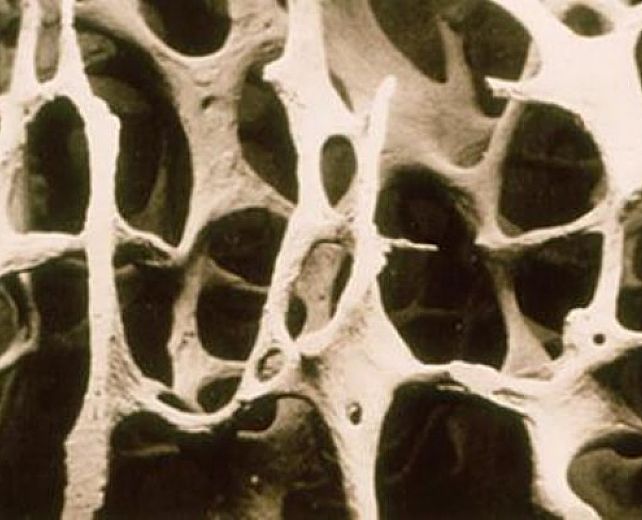 07102013 Osteoporosi