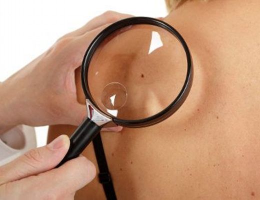 09042015 prevenzione melanoma