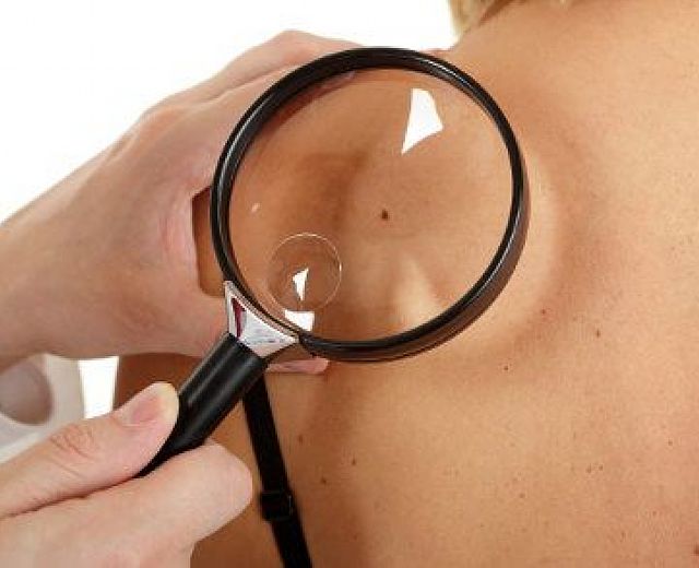 09042015 prevenzione melanoma