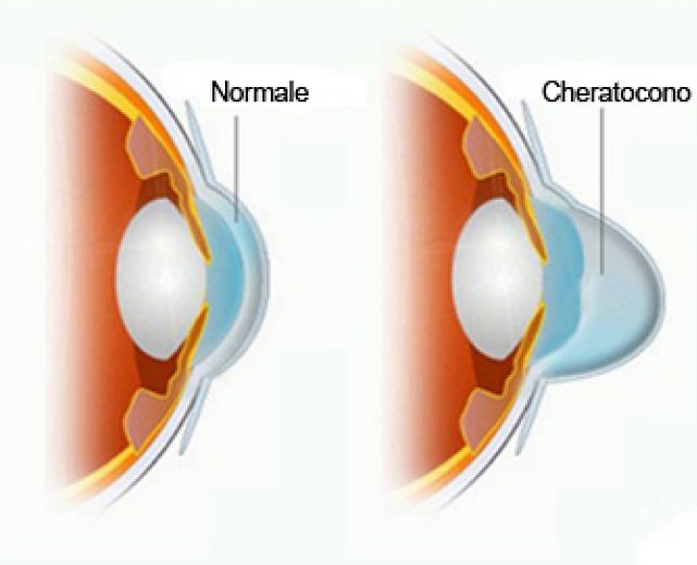 11092013 cheratocono