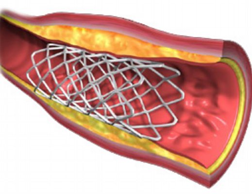 14112012 stent