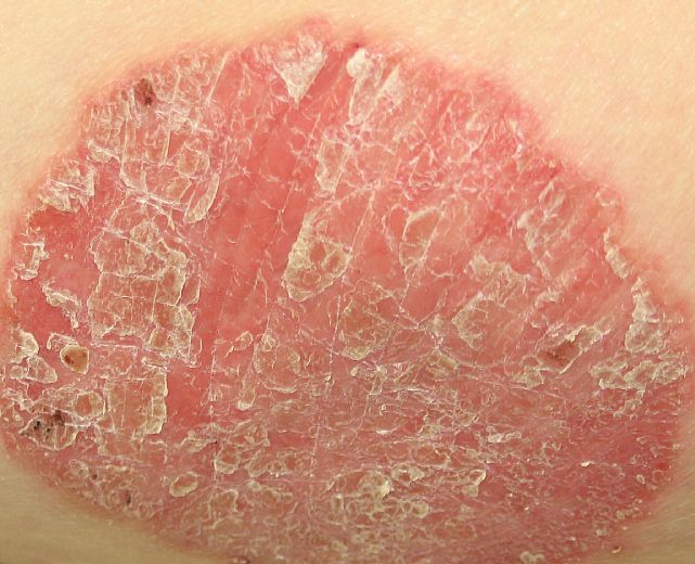 16032015 psoriasi chiazza