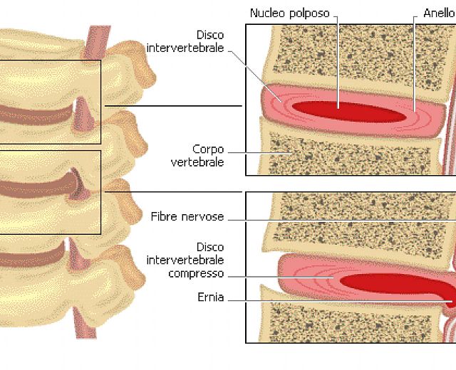 20052015 ernia del disco