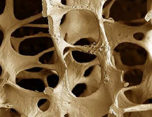 21092015 osteoporosi1
