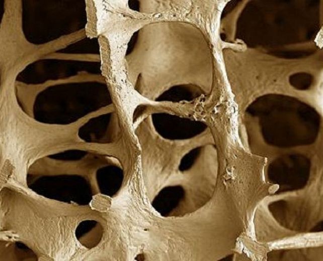 21092015 osteoporosi1
