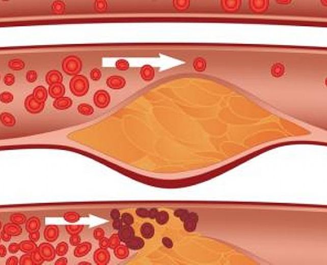 27112013 ipercolesterolemia