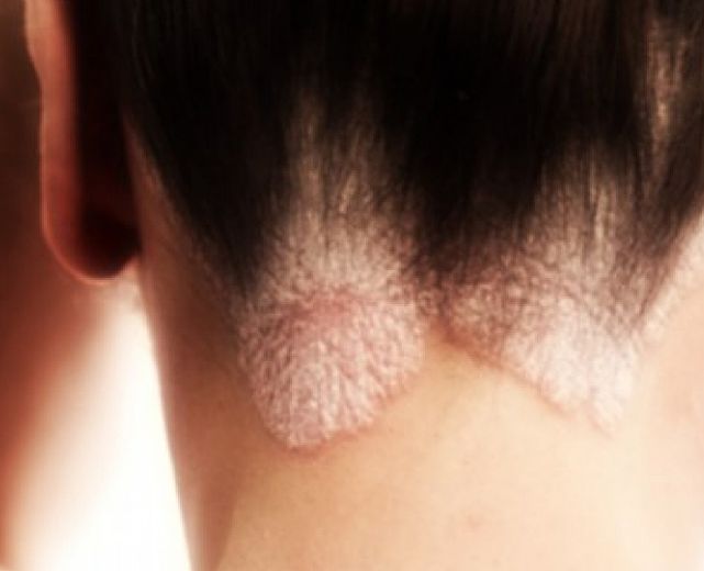 28042015 croste di psoriasi