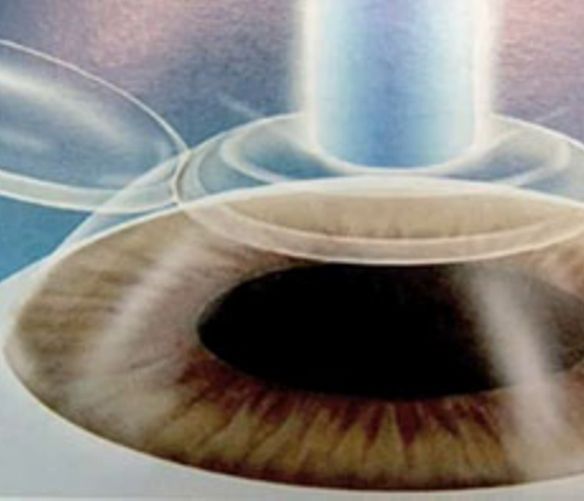 29092017 laser eccimeri