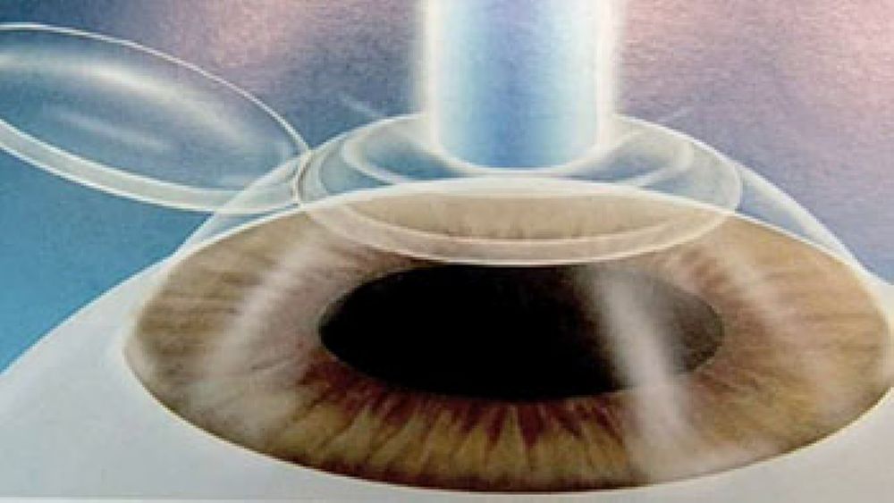 29092017 laser eccimeri