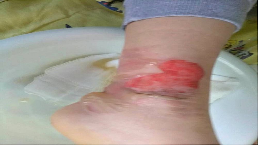 30012017 ustione bambino piede