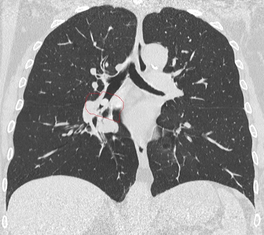 intervento corpo estraneo polmone