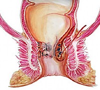 Chirurgia Colon rettale proctologica