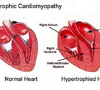 cardiomiopatia peripartum cardiomiopatia peripartum
