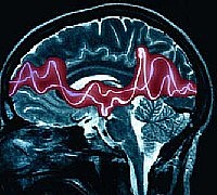 epilessia 01 epilessia 01