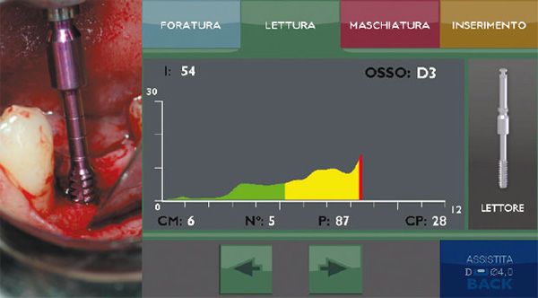 tecniche impianti denti