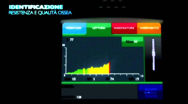 tecniche impianti denti