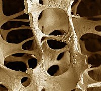 osteoporosi osteoporosi