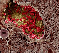 sem melanoma sem melanoma