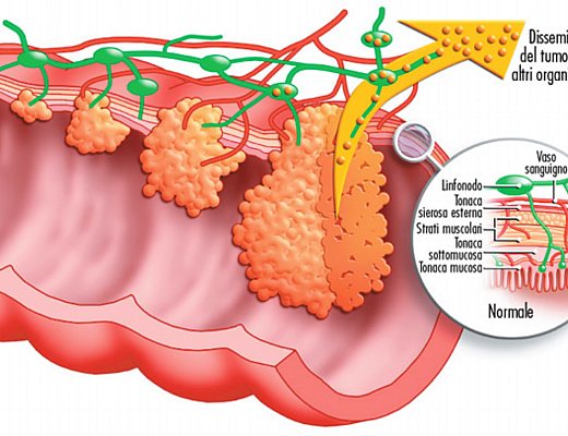 tumore al colon retto tumore al colon retto